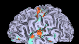 Emicrania, fotografata la neuroinfiammazione del nervo del dolore